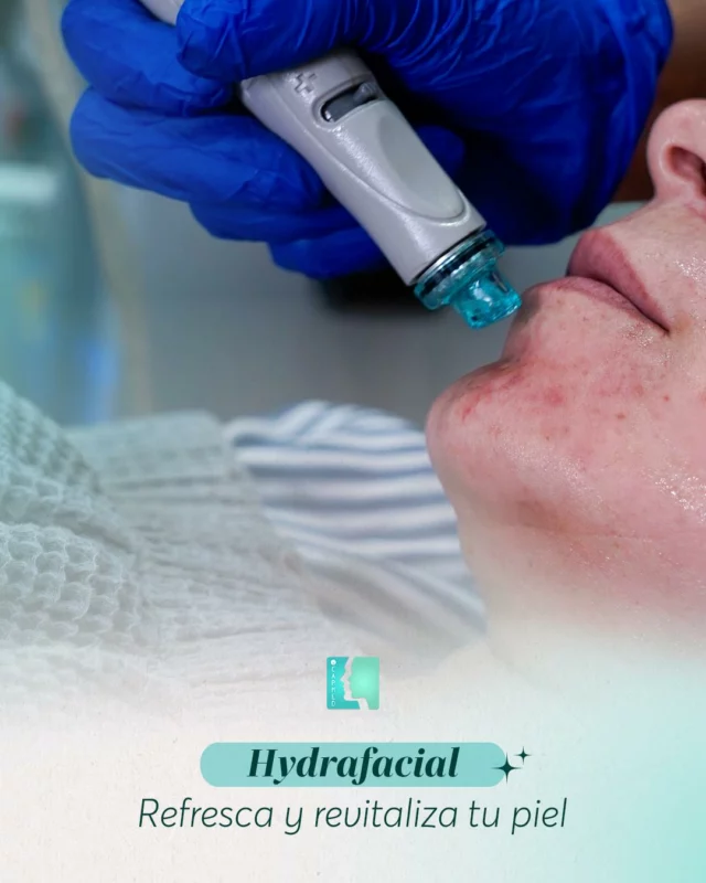 Hydrafacial / “Refresca y revitaliza tu piel” ✨ 
Tu piel también merece respirar.

Con Hydrafacial, limpias, nutres y renuevas en un solo paso.
 
Un mimo profundo que se nota por dentro… y por fuera. 💆‍♀️💧

📅 Reserva tu cita y luce una piel rejuvenecida.
📍 CAPMED | Santiago de los Caballeros
☎️ (809) 226-3616 - (829) 977-3616

#GlowUp #PielRadiante #CuidadoDeLaPiel #RejuvenecimientoFacial #Capmed