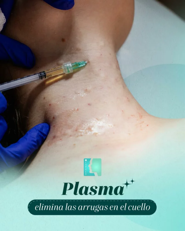 Plasma rico en plaquetas para cuello: suaviza, regenera y rejuvenece.
Sabemos que el cuello es una de las zonas donde más se nota el paso del tiempo…

💉 Menos arrugas, más confianza.

 Natural, seguro y con resultados progresivos.

📅 Agenda tu cita y empieza a brillar desde adentro.
📍 CAPMED | Santiago de los Caballeros
☎️ (809) 226-3616 - (829) 977-3616

#Toxinabotulínica #Capmed